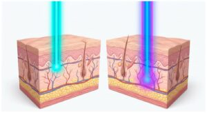두 가지 레이저 파장이 피부 층에 도달하는 3D 의학 삽화